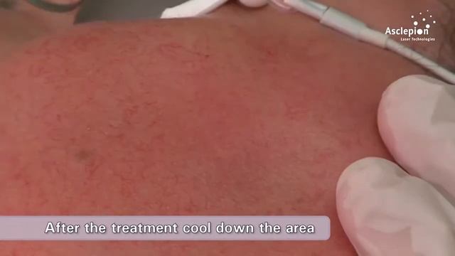 Лазерная терапия сосудов на QuadroStarPRO  от Asclepion