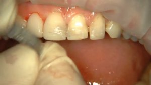 Реставрация зубов с помощью композитного материала