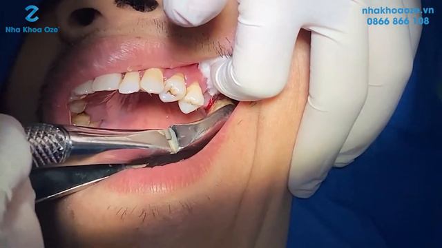 "CẢNH BÁO" - Phải nhổ bỏ răng hàm vì cao răng làm tụt lợi, viêm nha chu, hỏng răng | Nha Khoa Oze смотреть онлайн
