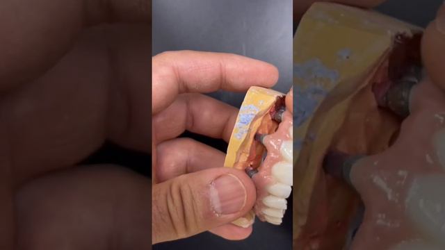 Циркониевые коронки на имплантантах 😍 #зубыдоипосле #отбеливаниезубов #лечениезубов