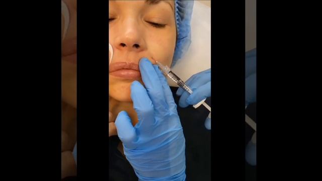 Устранение носогубной складки. смотреть онлайн