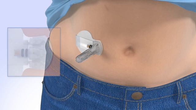 Inserting the Guardian™ Sensor 3 with the MiniMed™ 770G System смотреть онлайн