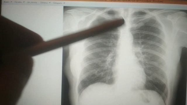 Описание снимка ОГК часть 2 смотреть онлайн