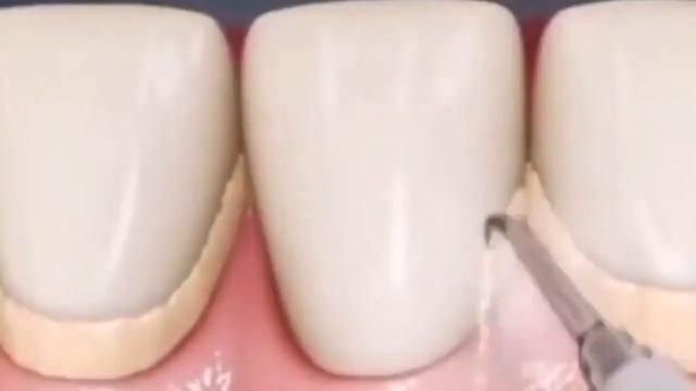 超音波口腔洗浄機 、高頻度振動 水が必要なく、歯茎を守る смотреть онлайн