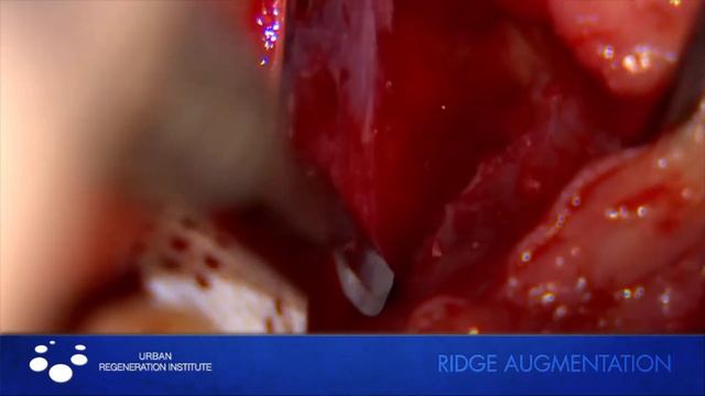 Dr. Istvan Urban: Vertical Ridge Augmentation W Reinforced PTFE Mesh (RPM)