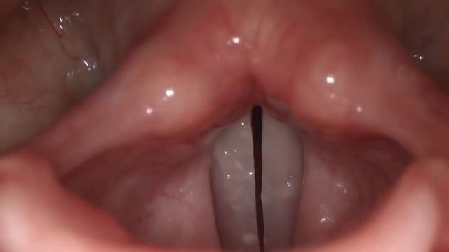Stroboscopy: Normal Female Vocal Cords