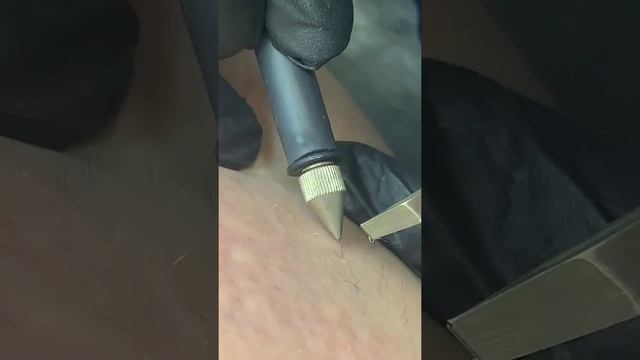 Электроэпиляции