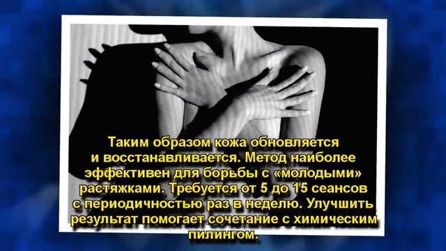 КАК ИЗБАВИТЬСЯ ОТ РАСТЯЖЕК смотреть онлайн