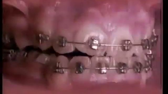 18 месяцев работы зубных брекетов за 60 секунд. Это стоит посмотреть смотреть онлайн