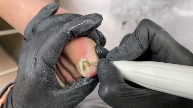 Онихолизис + синегнойка ??⚠️??? смотреть онлайн