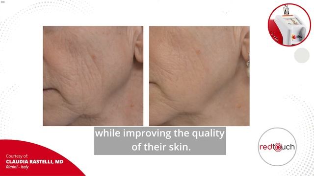 RedTouch by DEKA - an interesting evidence by Claudia Rastelli, MD смотреть онлайн