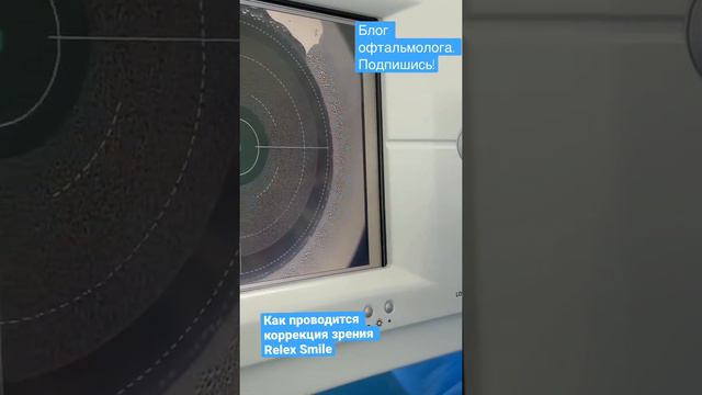 Как проводится коррекция зрения Relex Smile смотреть онлайн