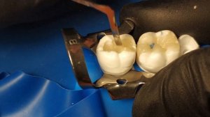 Реставрация зуба 4.7 (1й класс)/Tooth Restoration 4.7 (1st class) - Pogulyajlo Igor (student trains