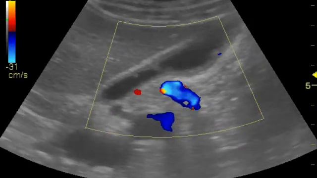 Холестероз желчного пузыря смотреть онлайн
