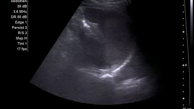 Добавочная долька селезенки смотреть онлайн