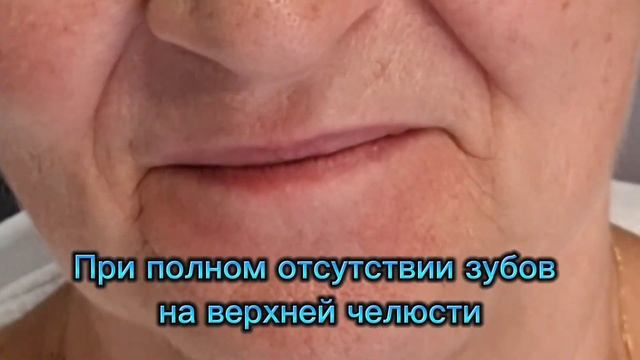 Протезирующая конструкция на имплантах. Стоматология Сочи смотреть онлайн