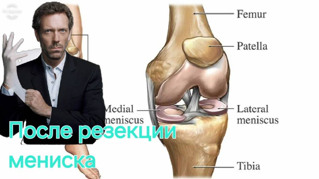 После операции , резекция мениска