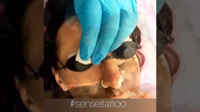 Карбоновый пилинг ниодимовым лазером смотреть онлайн