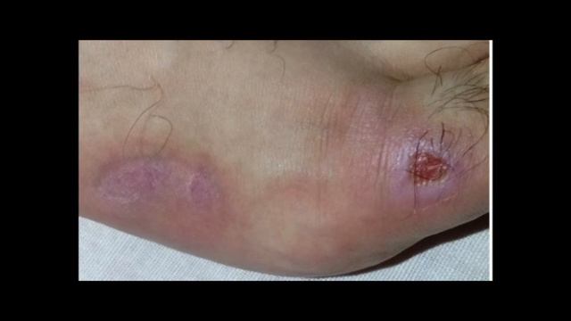 Лечим ожог сывороткой смотреть онлайн