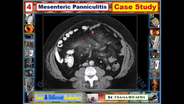 Mesenteric panniculitis - Radiology in GIT (4) смотреть онлайн