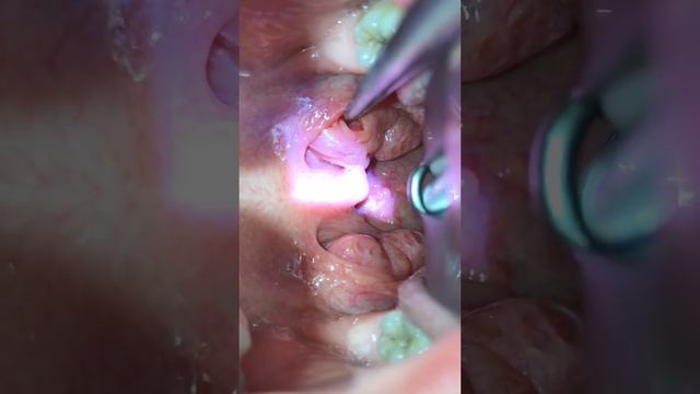 Tonsil stone removal смотреть онлайн