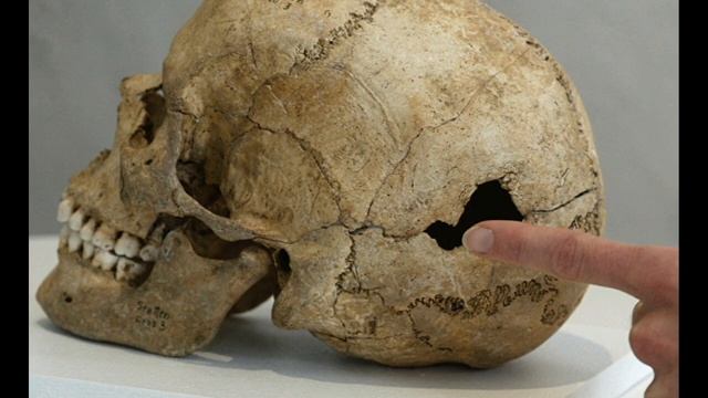 Трепанации в древние времена Загадки истории