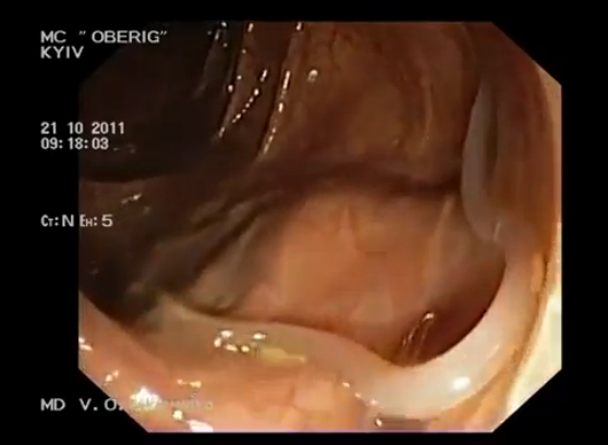 Паразиты в кишечнике: глисты,солитеры,аскариды,острицы,гельминты,черви (симптомы,признаки,лечение) смотреть онлайн