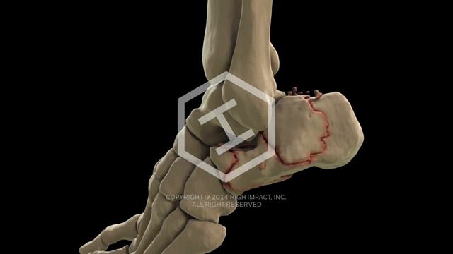 3D Volumetric Rendering of Calcaneus Fractures смотреть онлайн