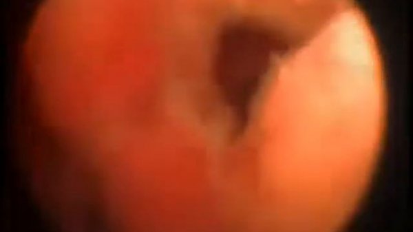 1  Ложный ход уретры на 1 час при катетеризации