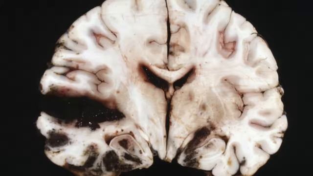 Difference Between Glioma and Glioblastoma смотреть онлайн
