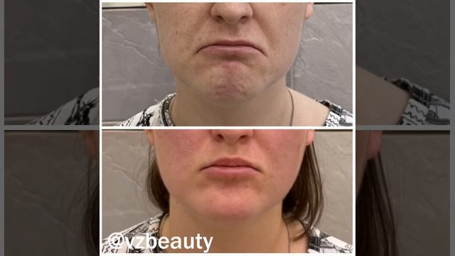 Что может ботокс в нижней трети лица смотреть онлайн