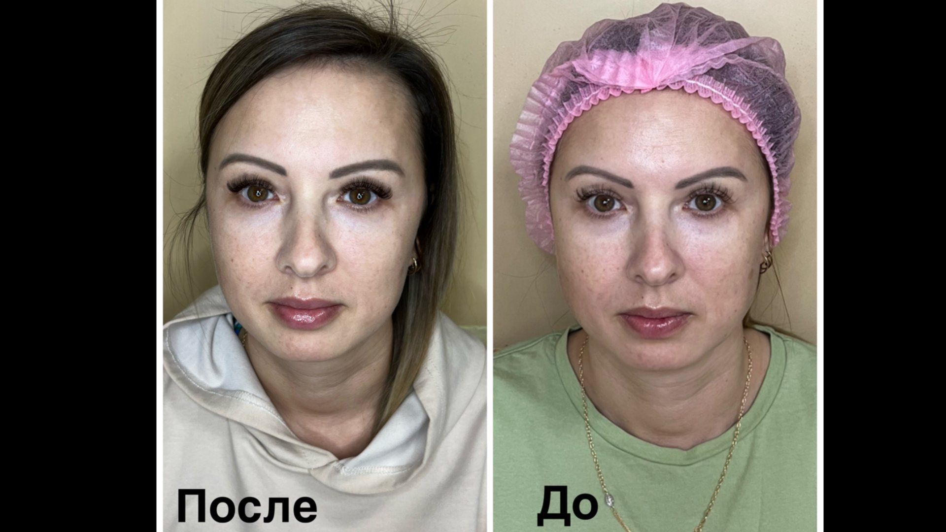 Ботулинотерапия в технике Full Face