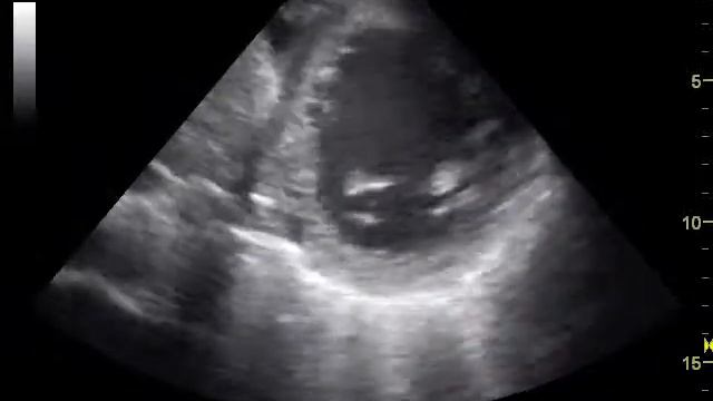 Образование в левом желудочке. Динамика смотреть онлайн