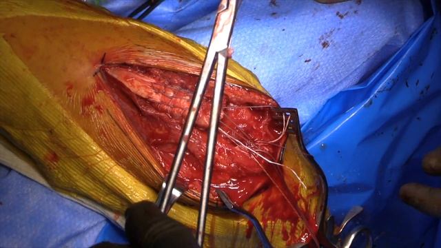 Distal Triceps Tendon Rupture Repair