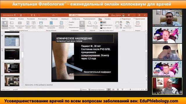 Вмешательства на перфорантных венах. Хирургия рецидива варикозной болезни смотреть онлайн