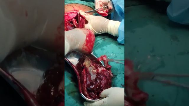 Steps of a Cesarean Section. смотреть онлайн
