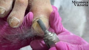 Рог-вместо ногтя?/ Онихогрифоз (птичий коготь). Сложный педикюр