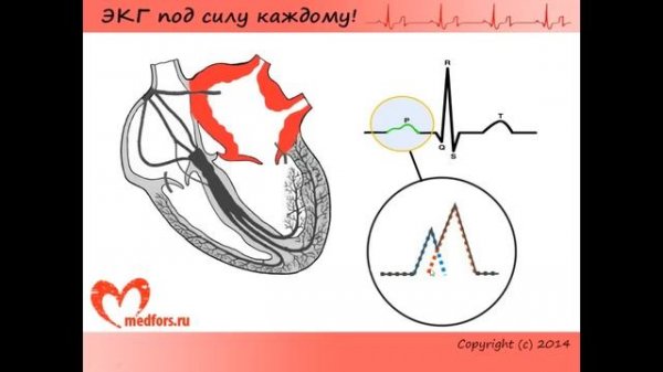 ЭКГ при гипертрофиях различных отделов сердца