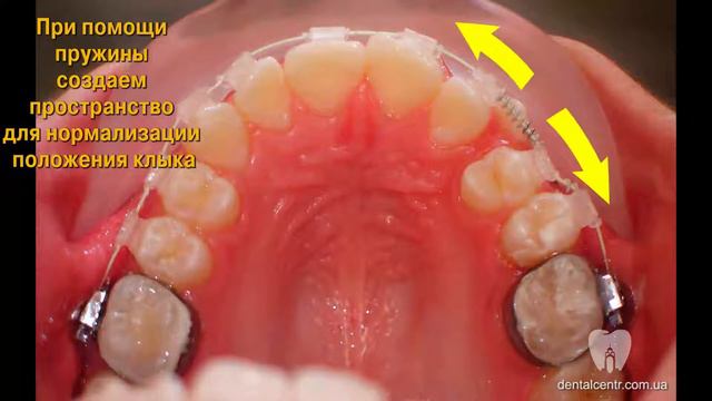 Прикольные брекеты смотреть онлайн