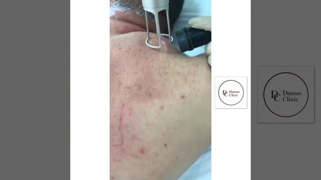 Комбинированная лазерная шлифовка спины в борьбе с постакне смотреть онлайн