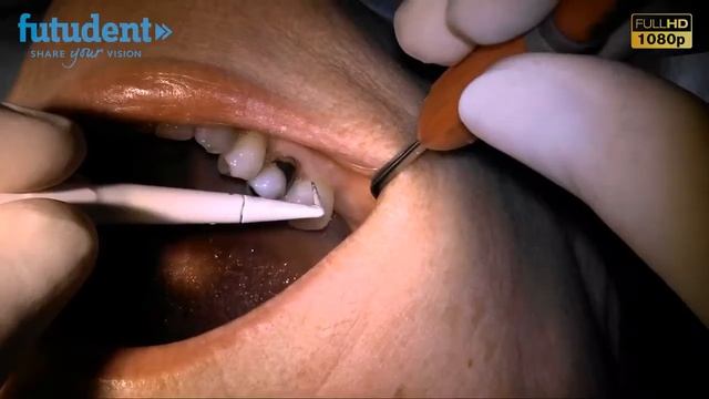 microCam - миниатюрная стоматологическая видеокамера с разрешением Full HD | Futudent (Финляндия) смотреть онлайн