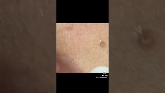 #асмр #прыщи #acne #acnetreatment #asmracne #давитьпрыщи#давкапрыщей