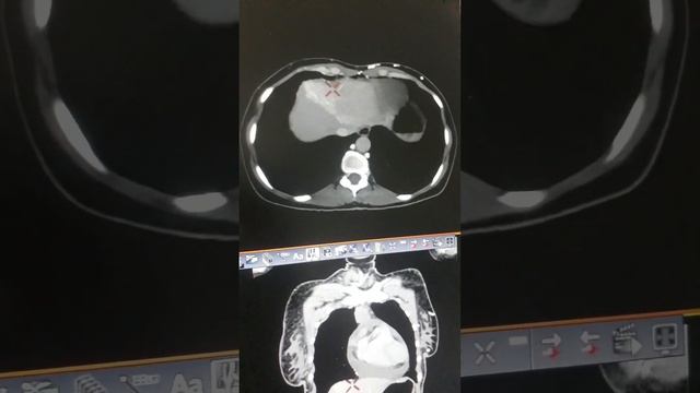 MEDIASTINAL LYMPHADENOPATHY#chest #cect#mediastinum#lymphaticsystem #lymphadepathy#ctscan #cectches смотреть онлайн