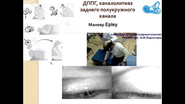 Доброкачественное пароксизмальное позиционное головокружение (ДППГ): диагностика и лечение смотреть онлайн