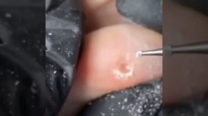 Фрезы для стержневой мозоли и не только