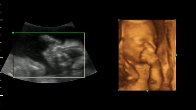 3D узи...8 месяцев....эпизод 3 смотреть онлайн