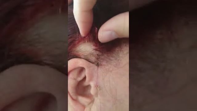 СМАС Лифтинг,Блефаропластика,ДЕНь 21ый. SMAS Facelifting , Augenlidstraffung, Fettabsaugung.21TAG смотреть онлайн