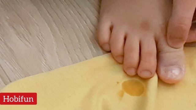 CANLI TEDAVİYE ÇOK ŞAŞIRACAKSINIZ?2 GÜNDE TIRNAK BATMASINDAN NASIL KURTULDUĞUMUZU SİZ DE İZLEYİN смотреть онлайн