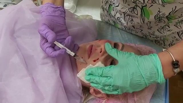 АирисКом студенты учатся: биоревитализации филорга Франция. смотреть онлайн