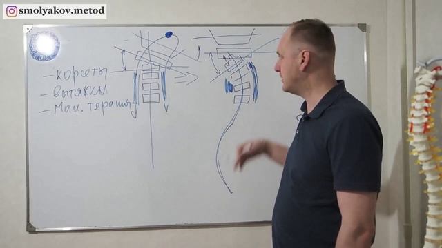 Мануальная терапия при сколиозе